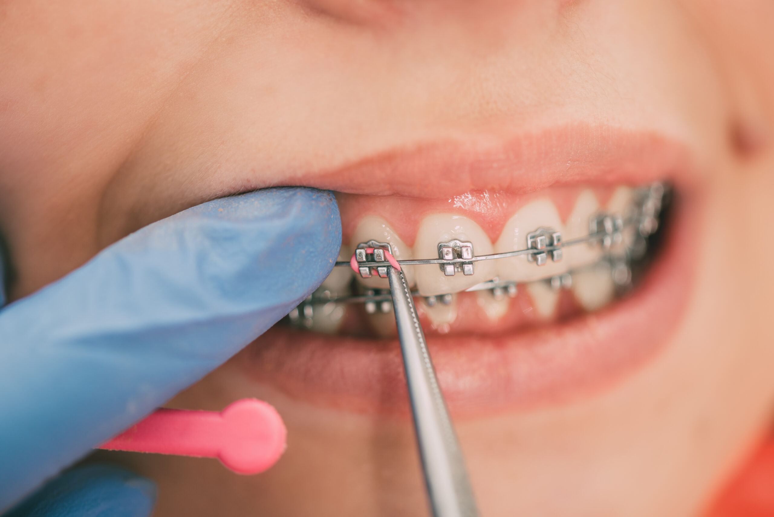 Pacientă purtând aparat dentar zâmbind în timpul controlului ortodontic