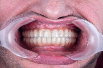 Urban Dental Hub - After Implant Thumbnail