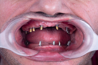 Urban Dental Hub - Before Implant thumbnail